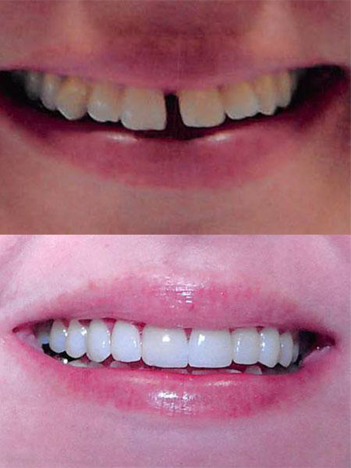 gapped and crooked teeth before treatment and straighter, whiter teeth after treatment