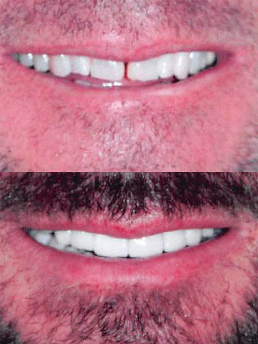 slightly gapped and uneven teeth before treatment, even and whiter teeth after treatment, also more facial hair