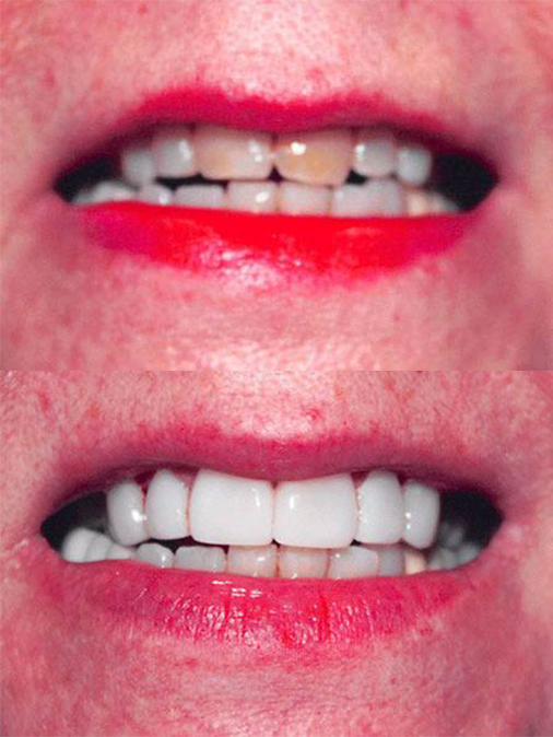 discolored and slightly misshapen teeth before treatment, white and properly shaped teeth after treatment