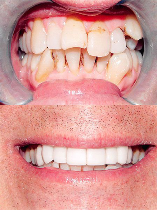 discolored and severely misaligned teeth before treatment, white and properly aligned teeth after treatment