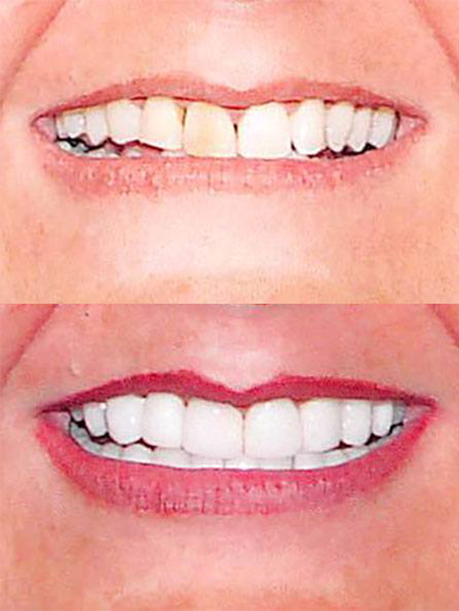 discolored and uneven teeth before treatment; white and evenly aligned teeth after treatment