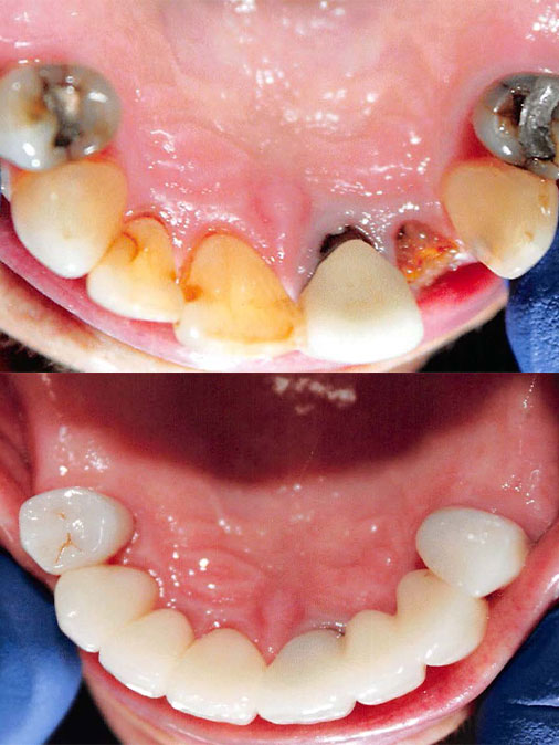 badly damaged teeth, missing tooth and amalgam restorations before treatment; white, even and restored teeth after treatment