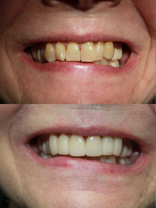 badly damaged teeth and missing tooth before treatment, fully restored and white teeth after treatment