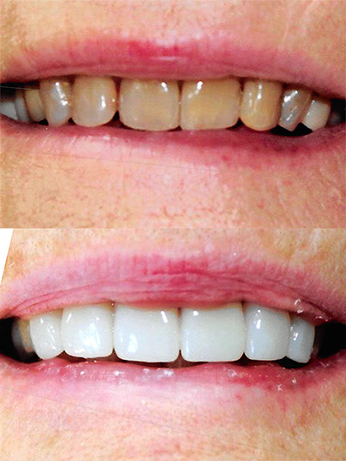 crooked and stained teeth before treatment and whiter and straighter teeth after treatment