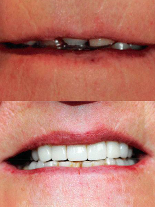 bad teeth, including metal crowns, before treatment and whiter, straight teeth after treatment