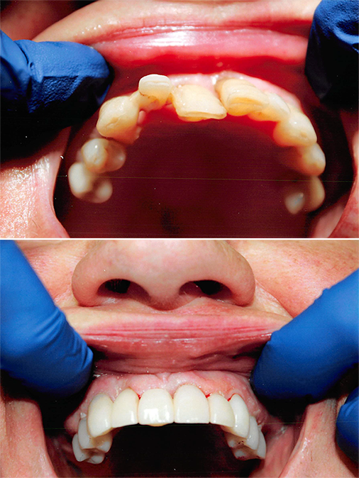 severely crooked teeth before treatment and properly aligned teeth after treatment