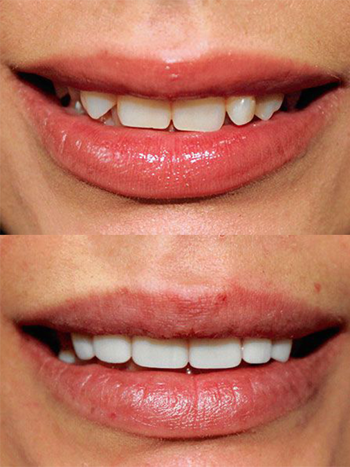 crooked teeth before treatment and straighter, better-shaped teeth after treatment