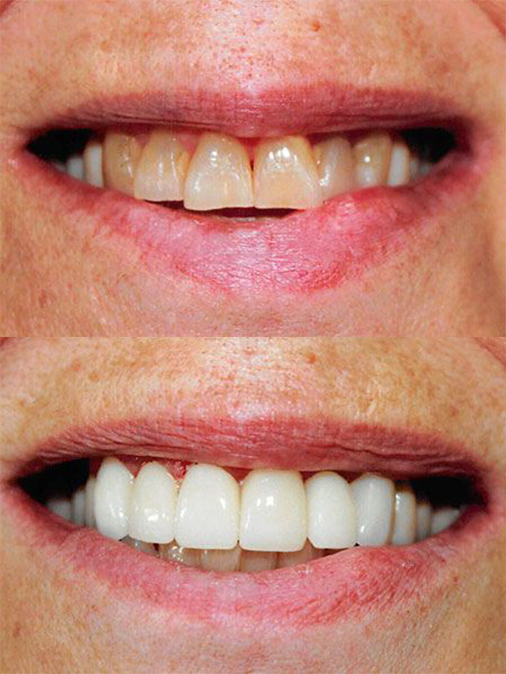 discolored and misshappen teeth before treatment, white and evenly shaped teeth after treatment