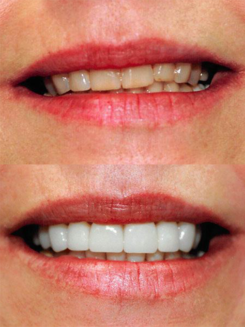 dull and uneven teeth before treatment, white and even teeth after treatment