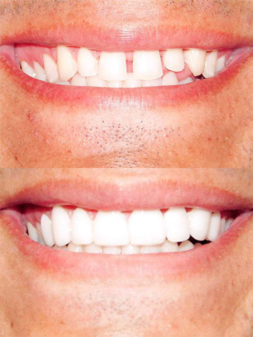 severely gapped and misaligned teeth before treatment, evenly spaced teeth after treatment
