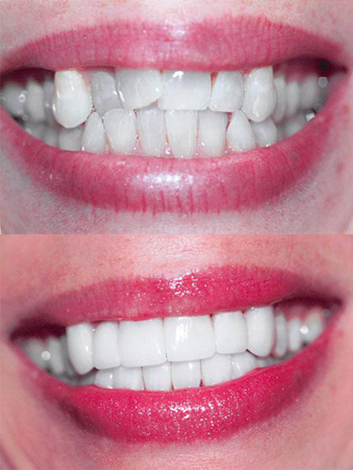 misaligned and grey teeth before treatment, properly aligned and white teeth after treatment