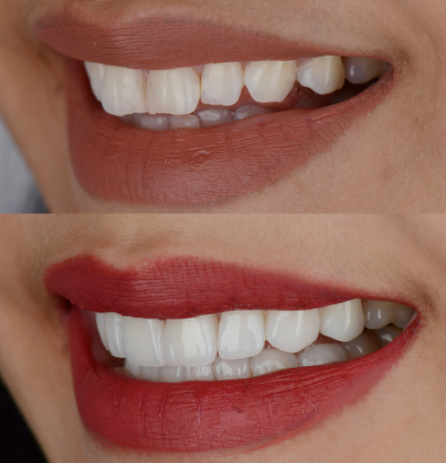 Teeth Whitening