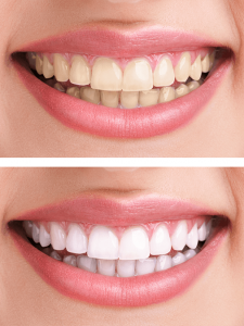 Teeth Whitening