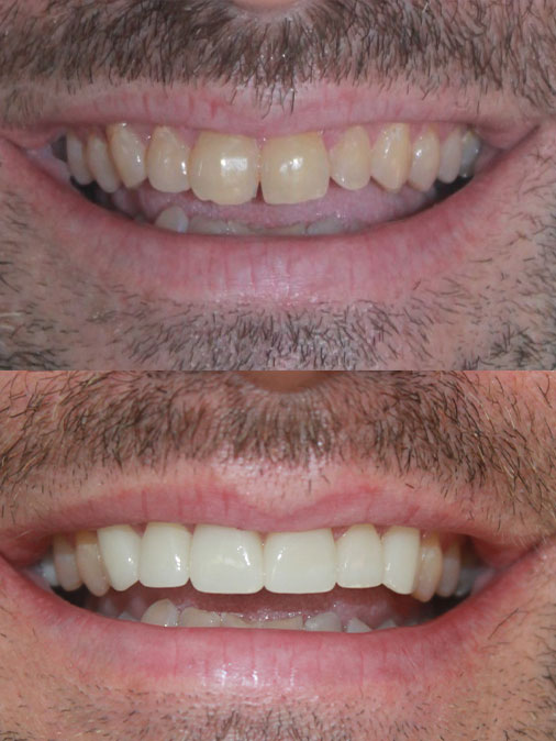 badly damaged teeth and missing tooth before treatment, fully restored and white teeth after treatment