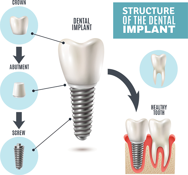 Dental Implant