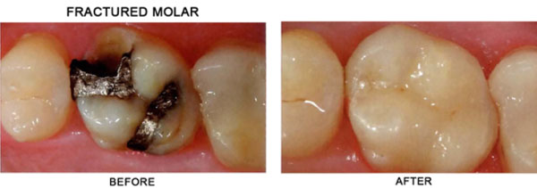 Fractured Molar before and after