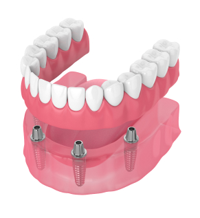 Dental Implants in Oklahoma City, OK