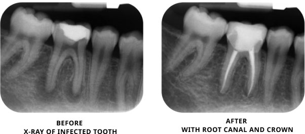 Root Canal x-ray before and after