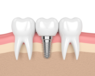 Dental Implants in Oklahoma City, OK