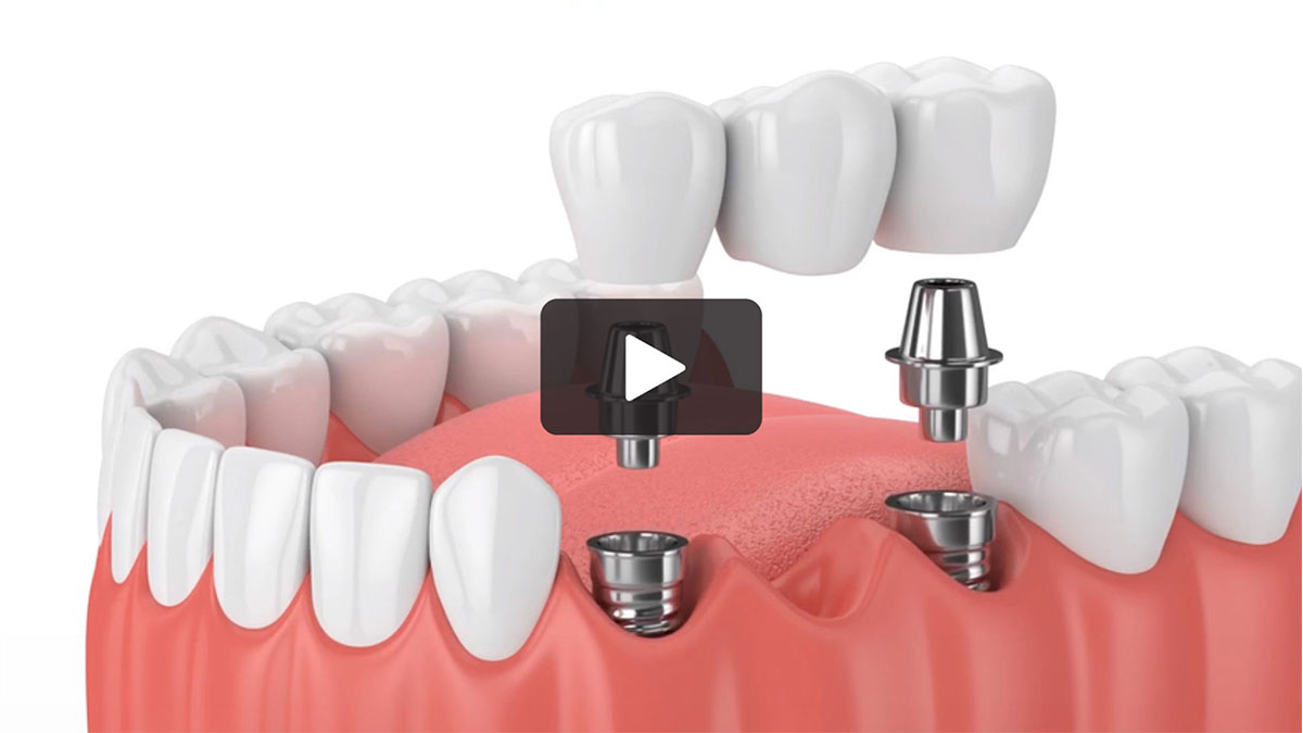 Dental Implant