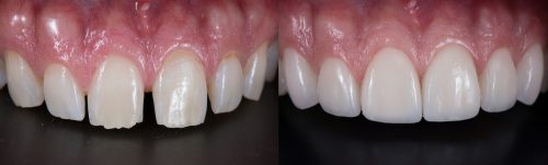 Dental Veneers in Oklahoma City, OK