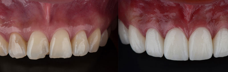 Before and after veneers treatment